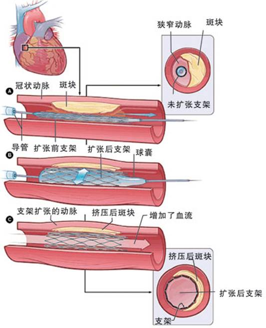 怎樣治療冠心??？(圖2)